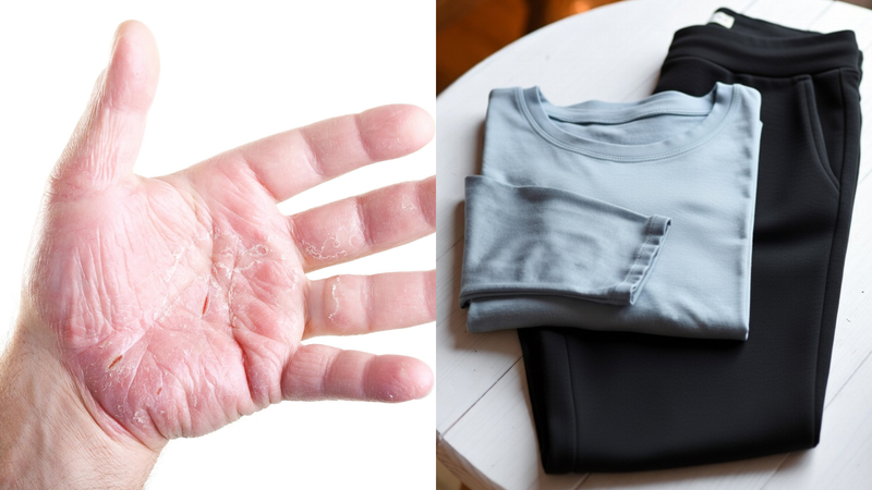 Understanding and Managing Hyperkeratotic Eczema